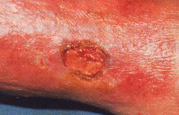 Úlcera varicosa