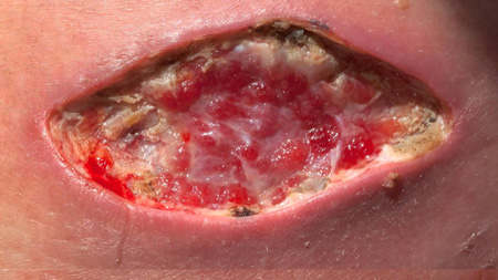 Cicatrizaci�n - herida cr�nica