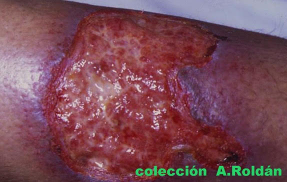 Jabón práctica milagro Úlceras vasculares: Tratamiento | Úlceras.net