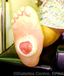 ulcera en pie con atropatia de Charcot