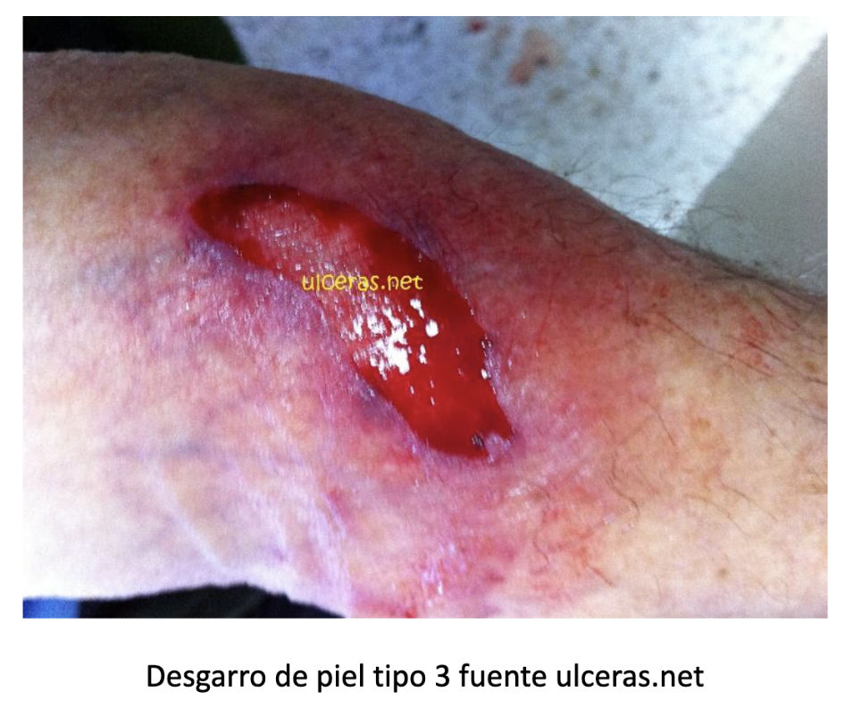 Desgarros cut�neos - Ulceras.net