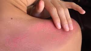 How to treat first-degree burn wounds? - ALHYDRAN